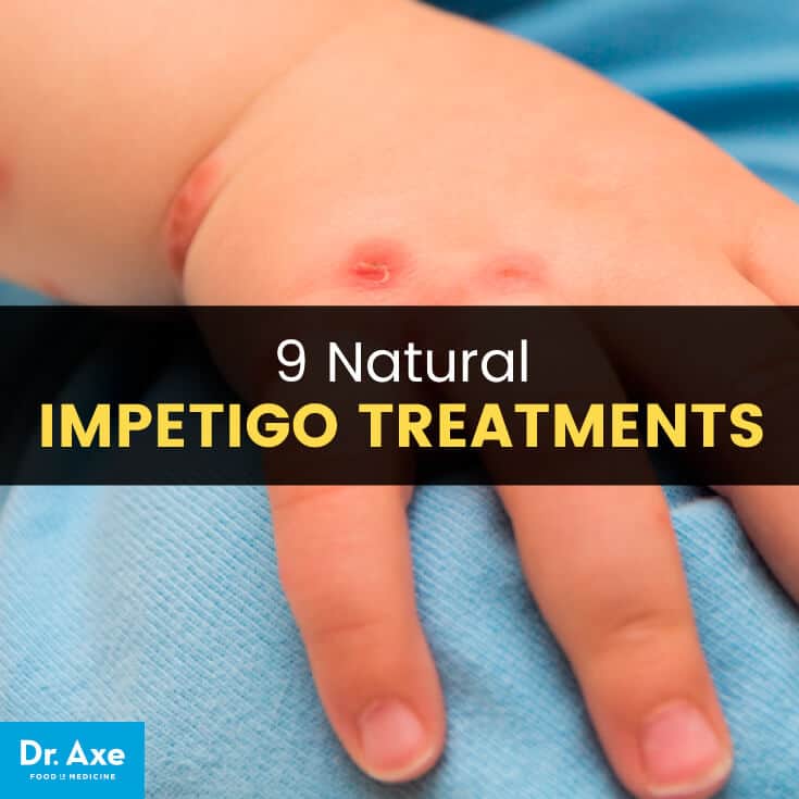 Impetigo natural treatments - Dr. Axe