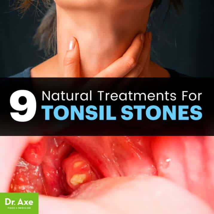 Tonsil Stones Causes Symptoms And Treatment Options Dr Axe