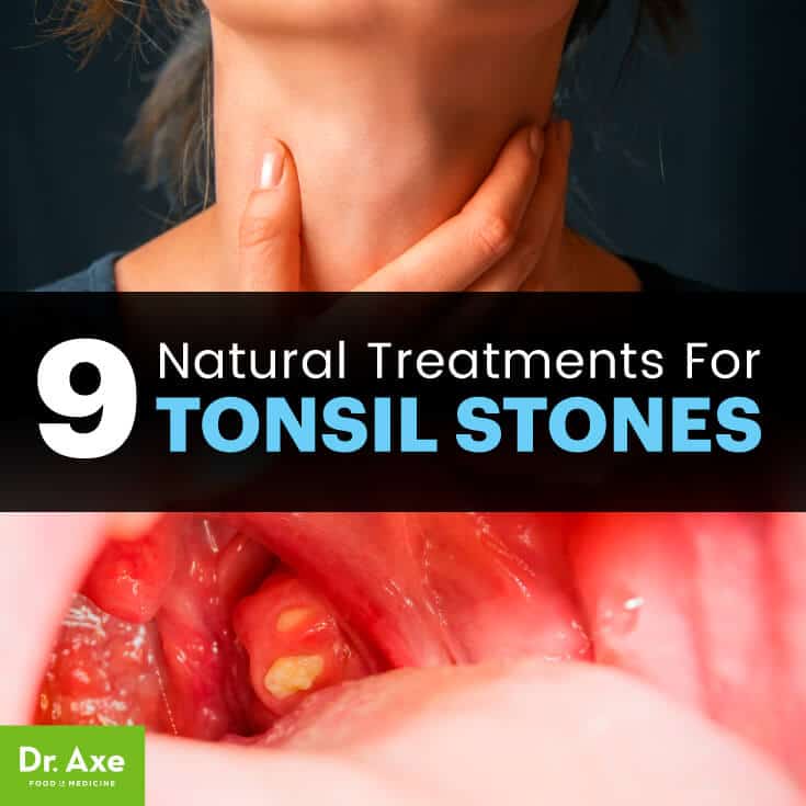 Tonsil stones