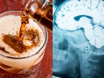 Artificially sweetened drinks increase risk of stroke and dementia - Dr. Axe