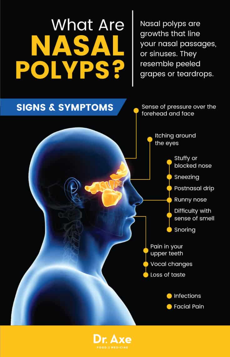 What are nasal polyps?