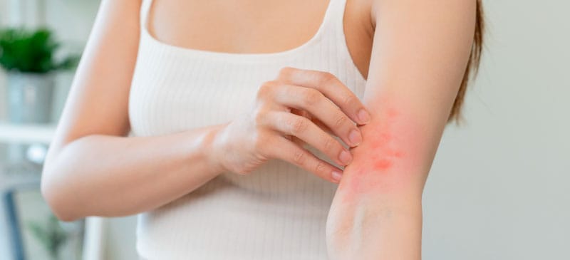 Eczema treatment - Dr. Axe