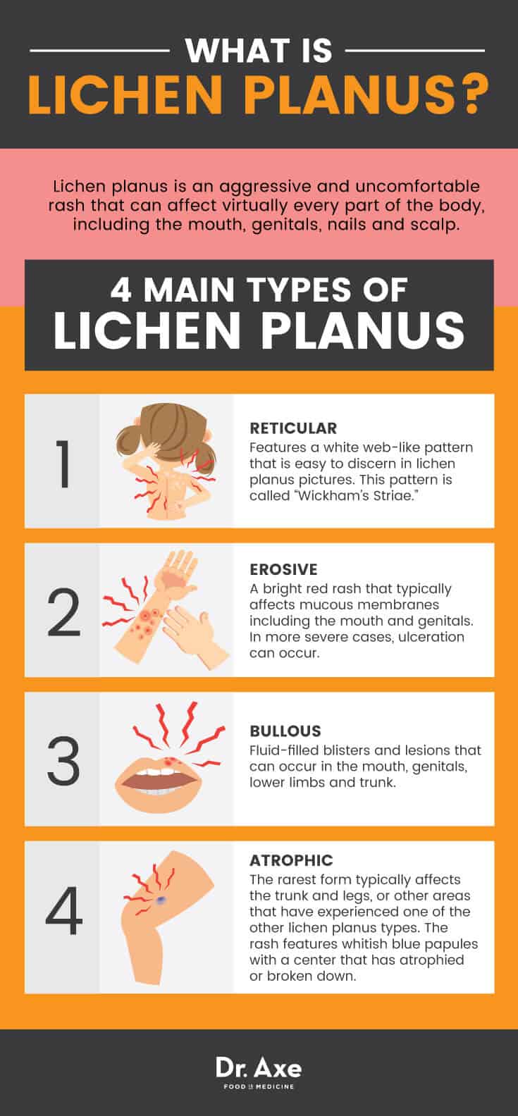 What is lichen planus? - Dr. Axe