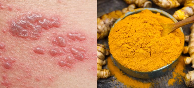 Lichen Planus 9 Natural Ways To Treat This Nasty Rash Dr Axe 9003