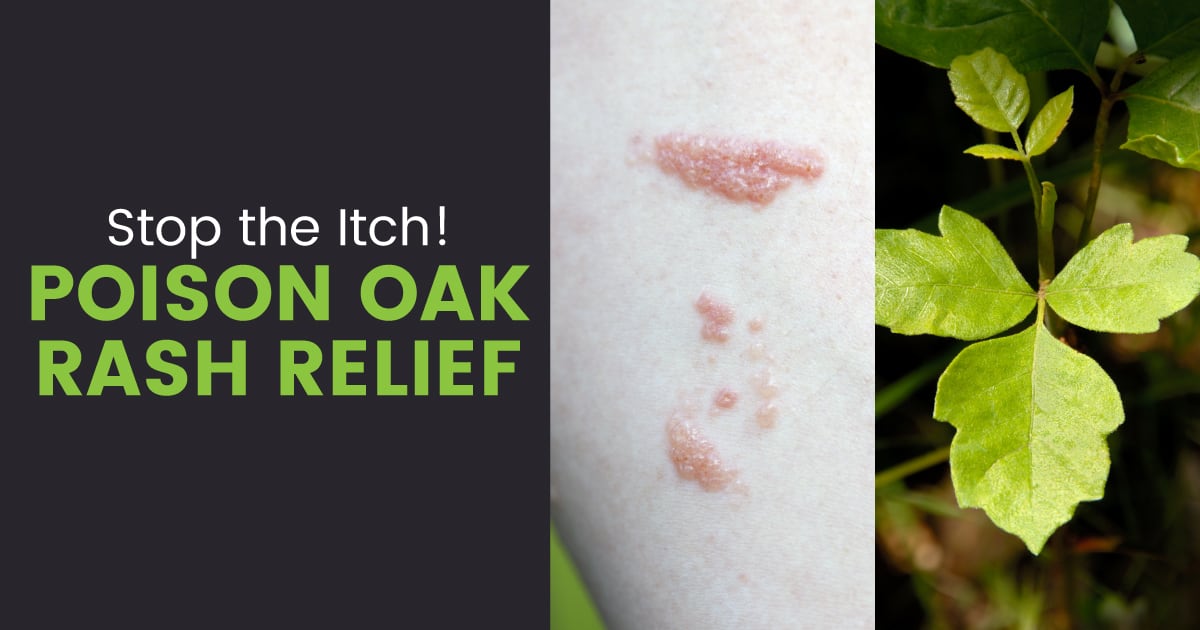 Poison Oak Rash Symptoms + 5 Soothing Natural Treatments - Dr. Axe