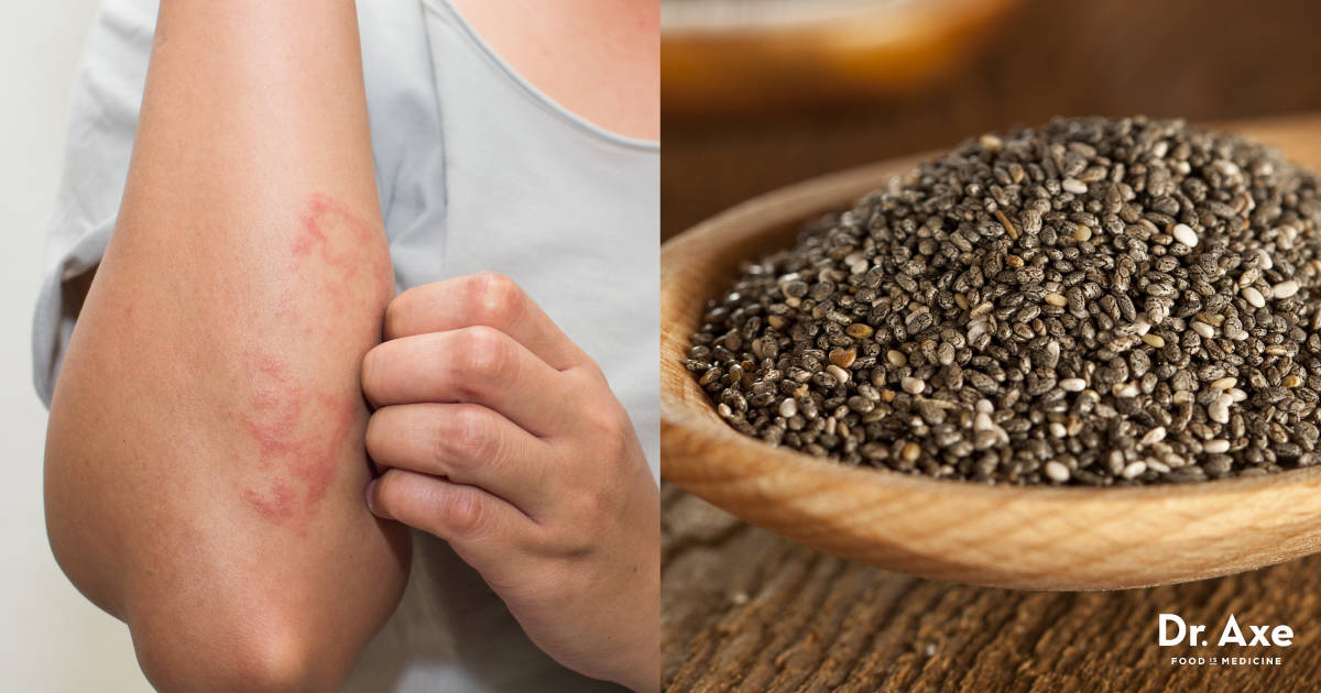How to Get Rid of a Rash: 6 Natural Rash Remedies - Dr. Axe