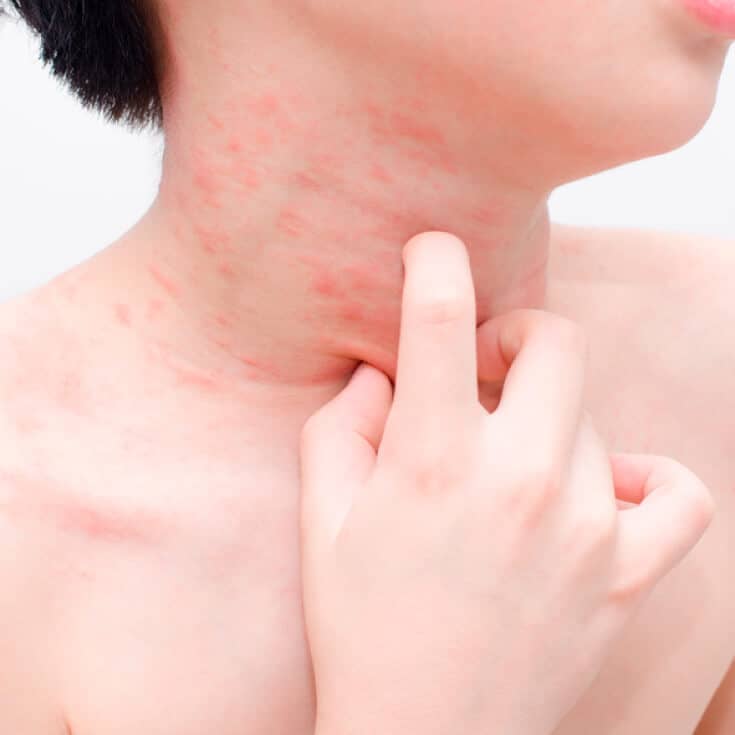 streptococcal pharyngitis rash