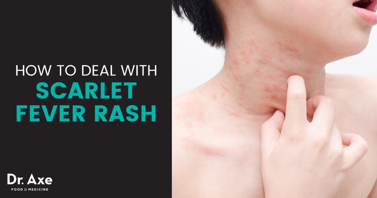 Scarlet Fever Rash Relief 10 Soothing Natural Treatments Dr Axe