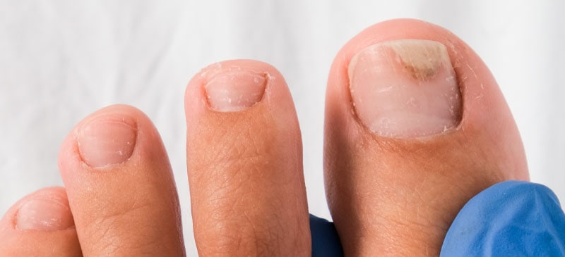 Nail Fungus Frequently Asked Questions | EMUAID®️