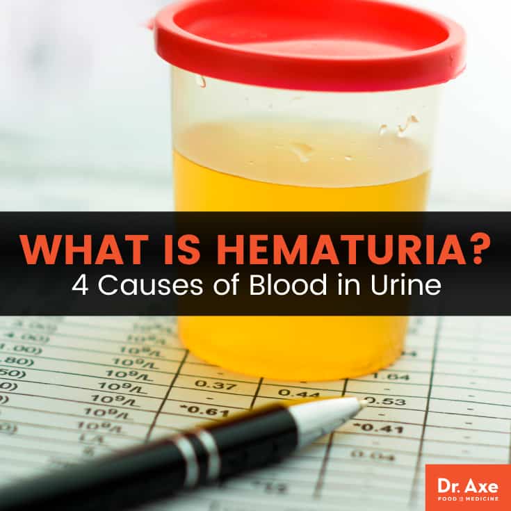 What is hematuria? - Dr. Axe