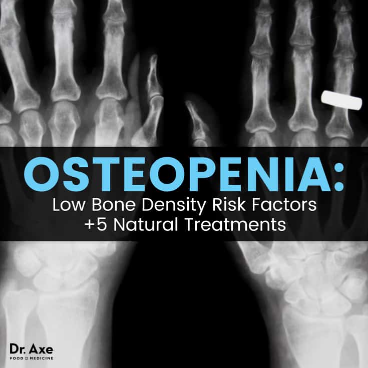 Osteopenia Low Bone Density Risk Factors 5 Natural Treatments Get Collagen Supplements South Africa