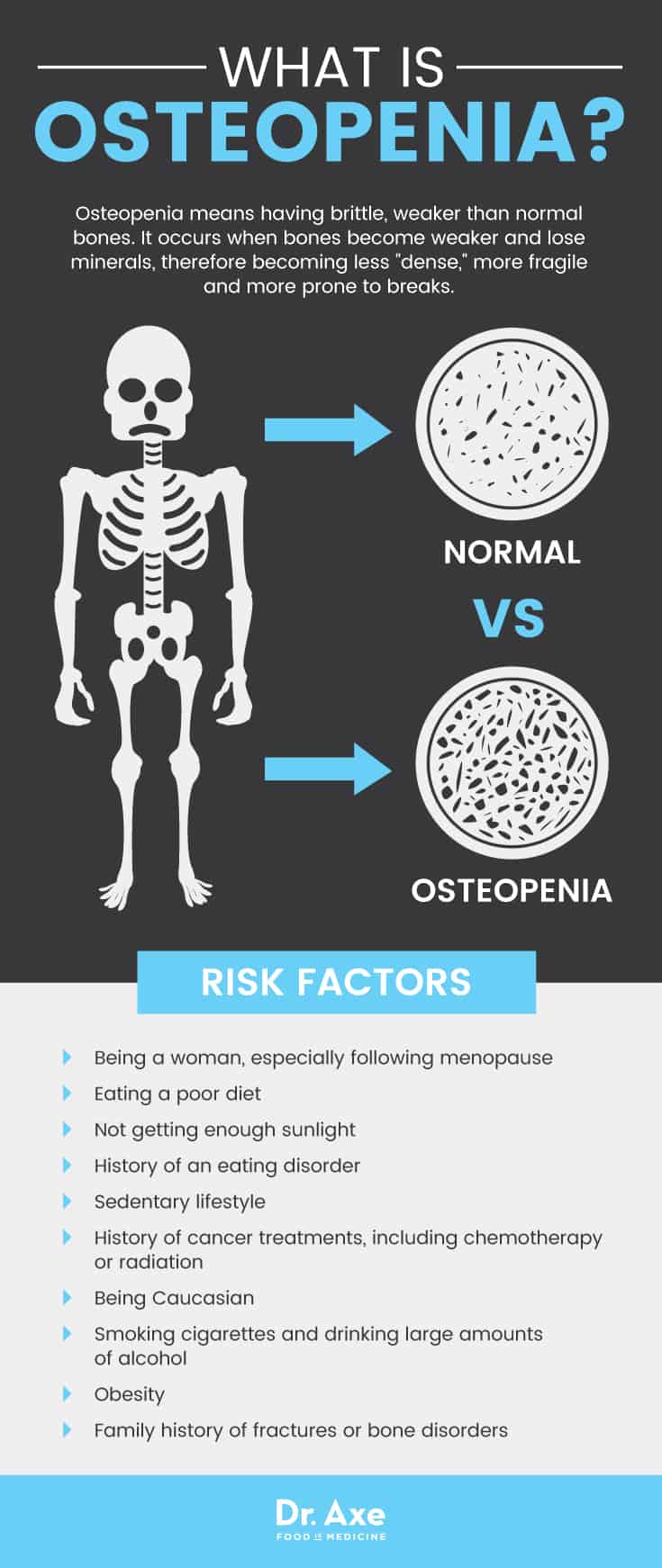 Osteopenia risk factors - Dr. Axe