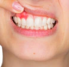 Receding gums - Dr. Axe