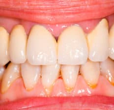 Receding gums - Dr. Axe