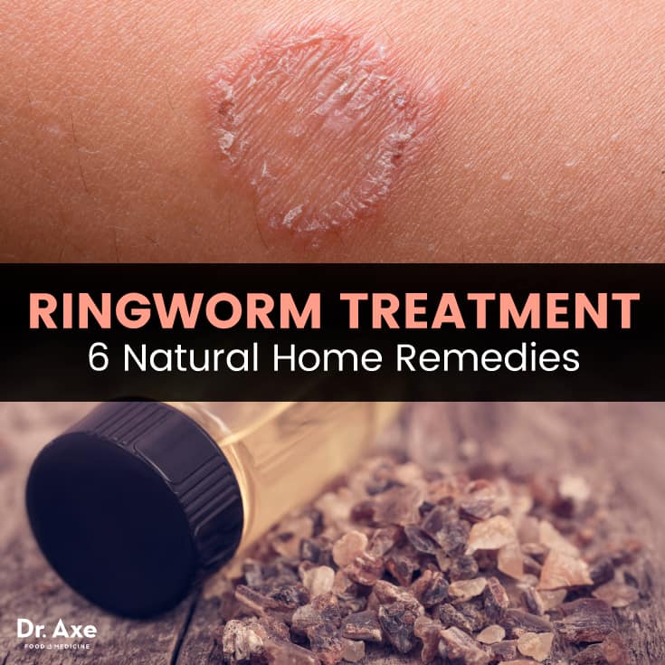 Ringworm Treatment - Dr. Axe