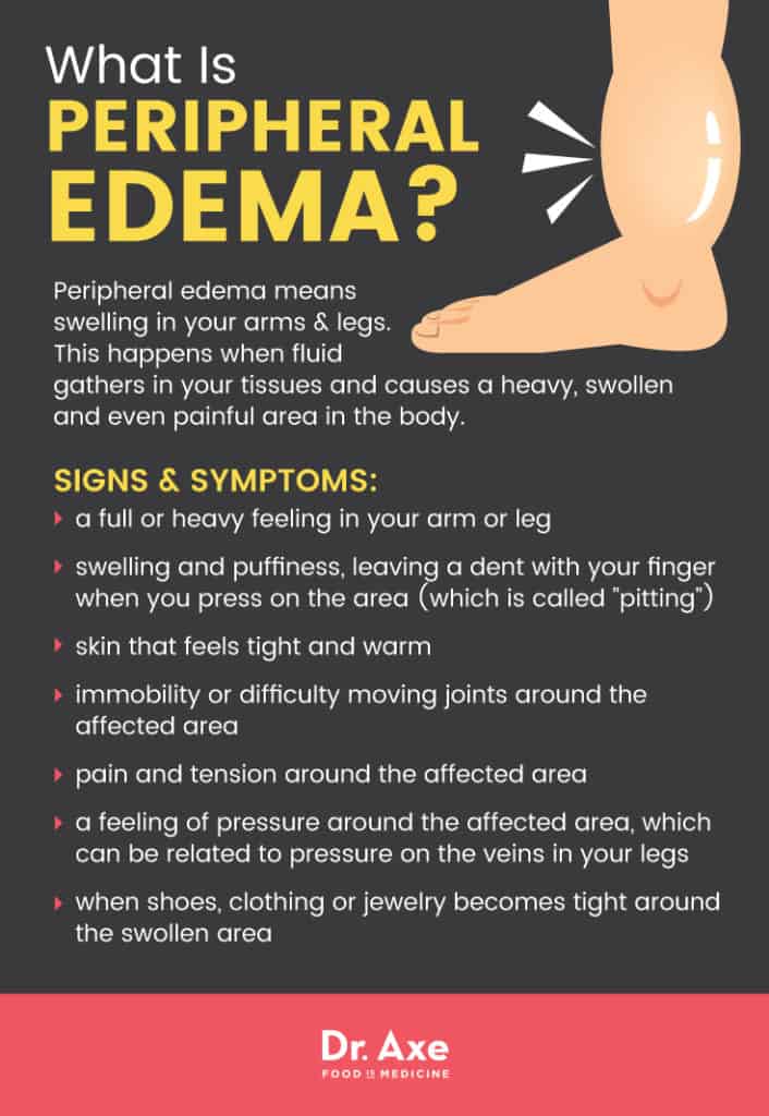 travel related edema