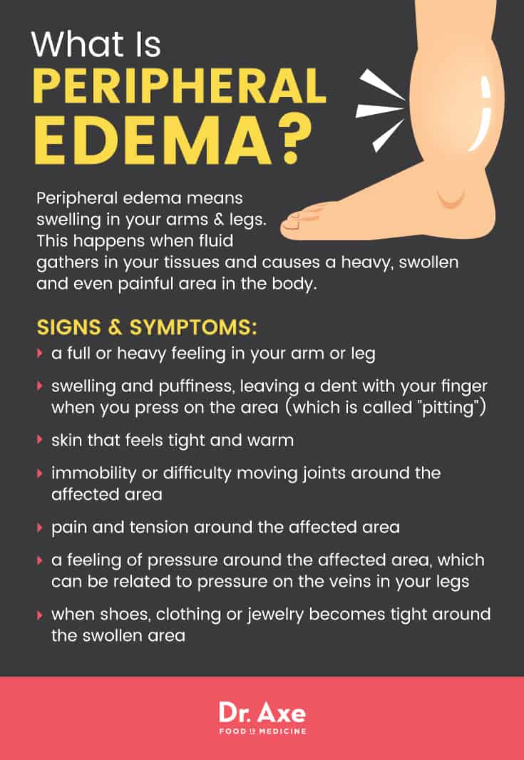 Peripheral Edema Symptoms 7 Natural Treatments Dr Axe