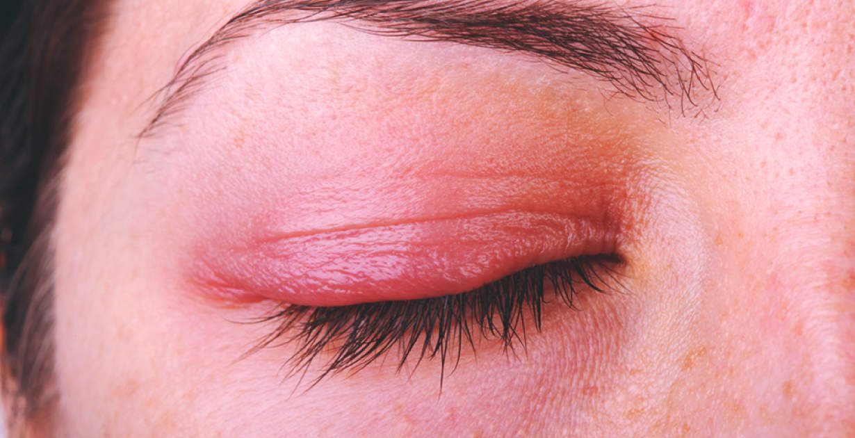 Painful deals swollen eyelid