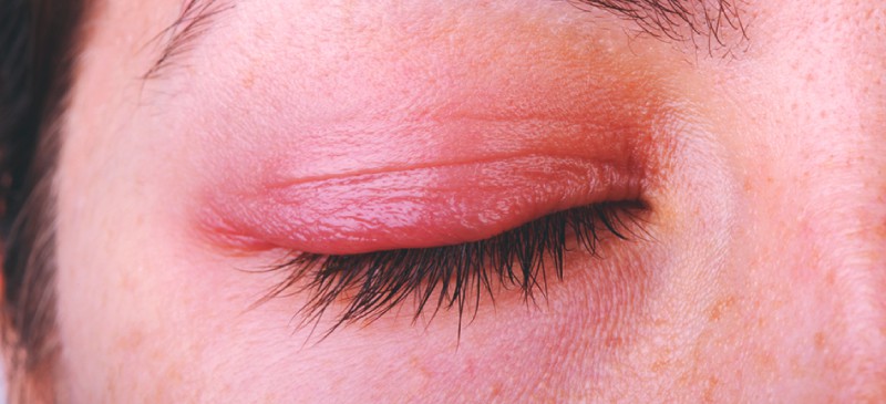 How To Soothe Irritated Skin Around Eyes