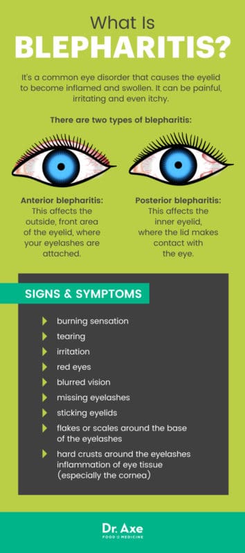 Blepharitis: 7 Natural Treatments To Soothe An Inflamed Eyelid - Dr. Axe