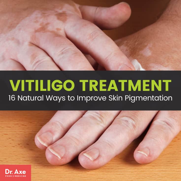 Vitiligo Treatment 16 Natural Ways to Improve Pigmentation Dr. Axe