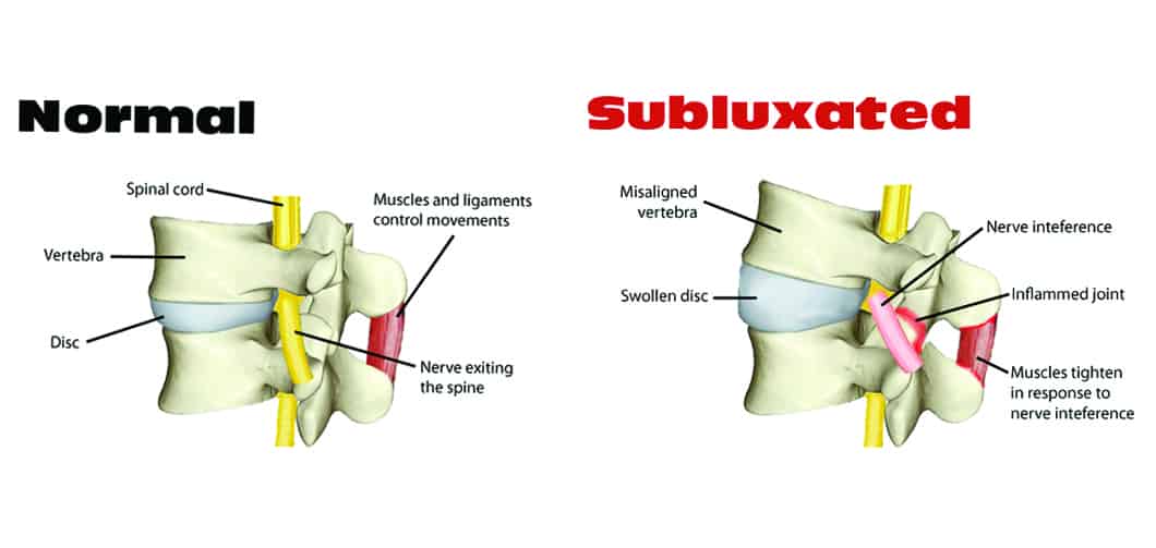 Normal vs. subluxated joint - Dr. Axe
