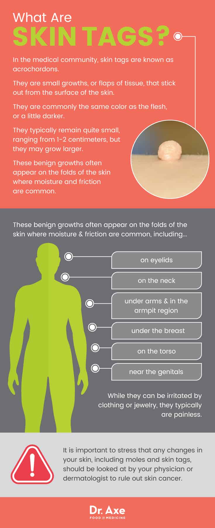 skin tags on neck removal