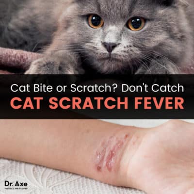 Cat Scratch Fever: See Your Doctor + Find Natural Relief - Dr. Axe