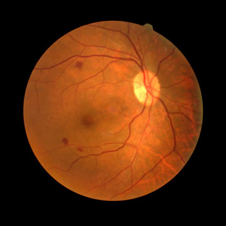 Diabetic Retinopathy Prevention & Management: 12 Natural Tips - Dr. Axe