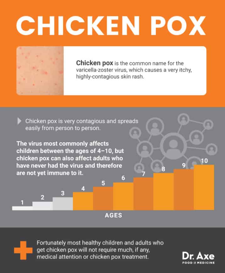 Chicken Pox Treatment: Natural Home Remedies - Dr. Axe