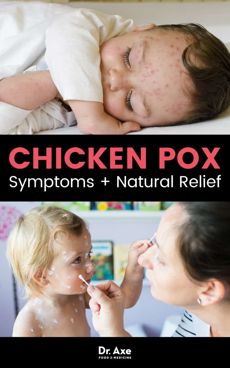 Chicken pox symptoms - Dr. Axe