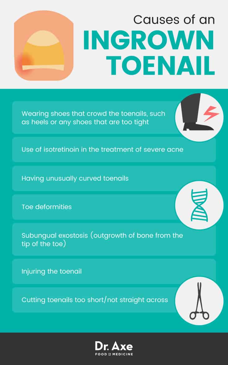 Causes of an ingrown toenail - Dr. Axe