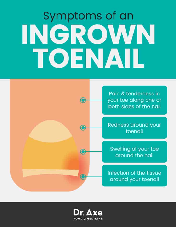 Symptoms of an ingrown toenail - Dr. Axe