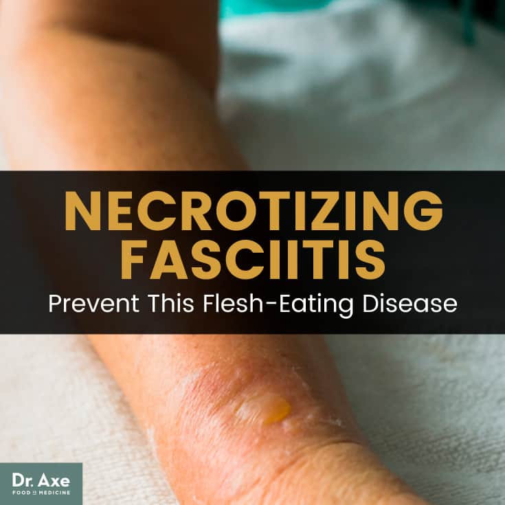 Necrotizing fasciitis - Dr. Axe