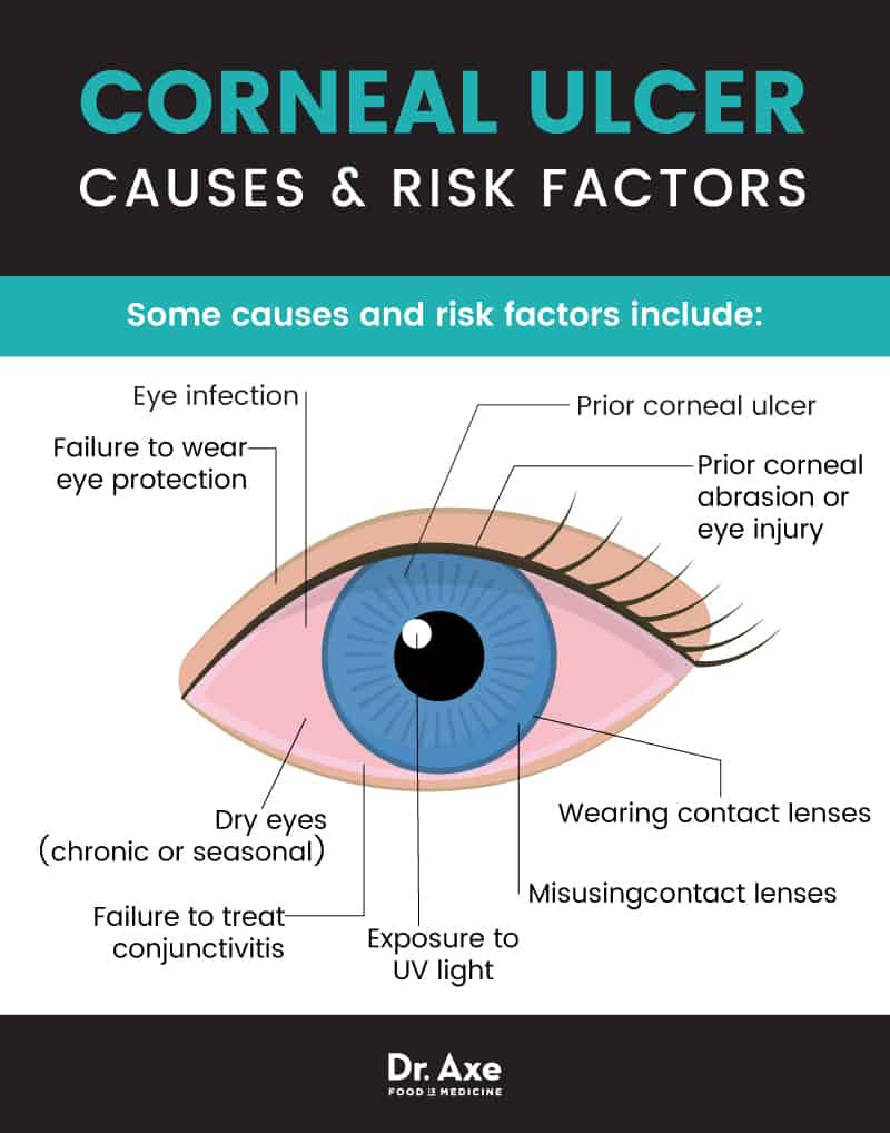 Corneal ulcer causes & risk factors - Dr. Axe