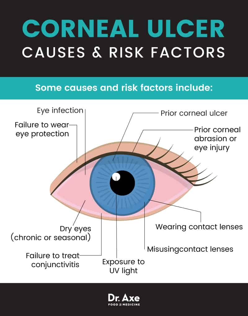 Corneal Ulcer Symptoms + Relieve Symptoms 11 Natural Ways - Dr. Axe