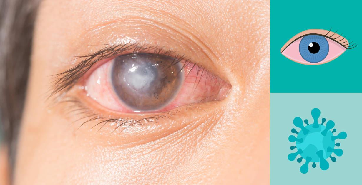 Will A Corneal Ulcer Go Away On Its Own Infoupdate