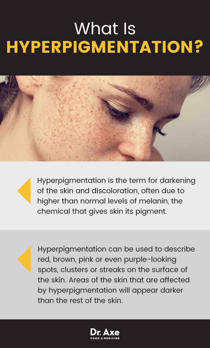 What is hyperpigmentation? - Dr. Axe