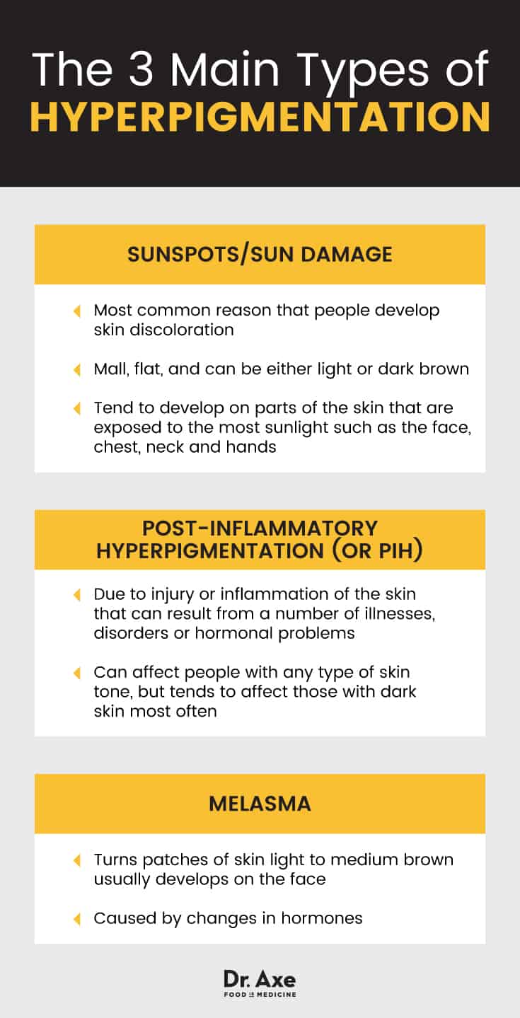 3 main types of hyperpigmentation - Dr. Axe