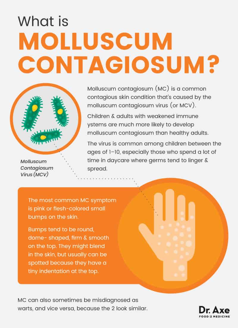 What is molluscum contagiosum? - Dr. Axe