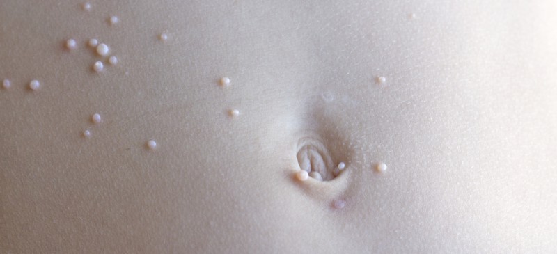 Molluscum contagiosum - Dr. Axe