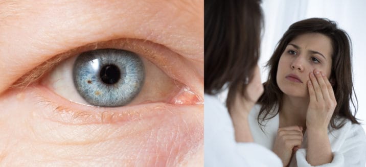 Ptosis Causes + 8 Natural Treatments for a Drooping Eyelid - Dr. Axe