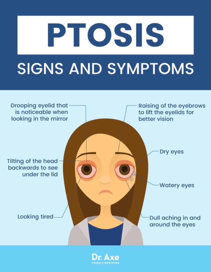 Ptosis Causes 8 Natural Treatments For A Drooping Eyelid Dr Axe 