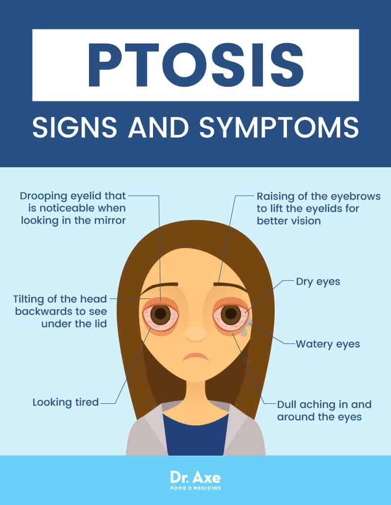 Ptosis signs & symptoms - Dr. Axe