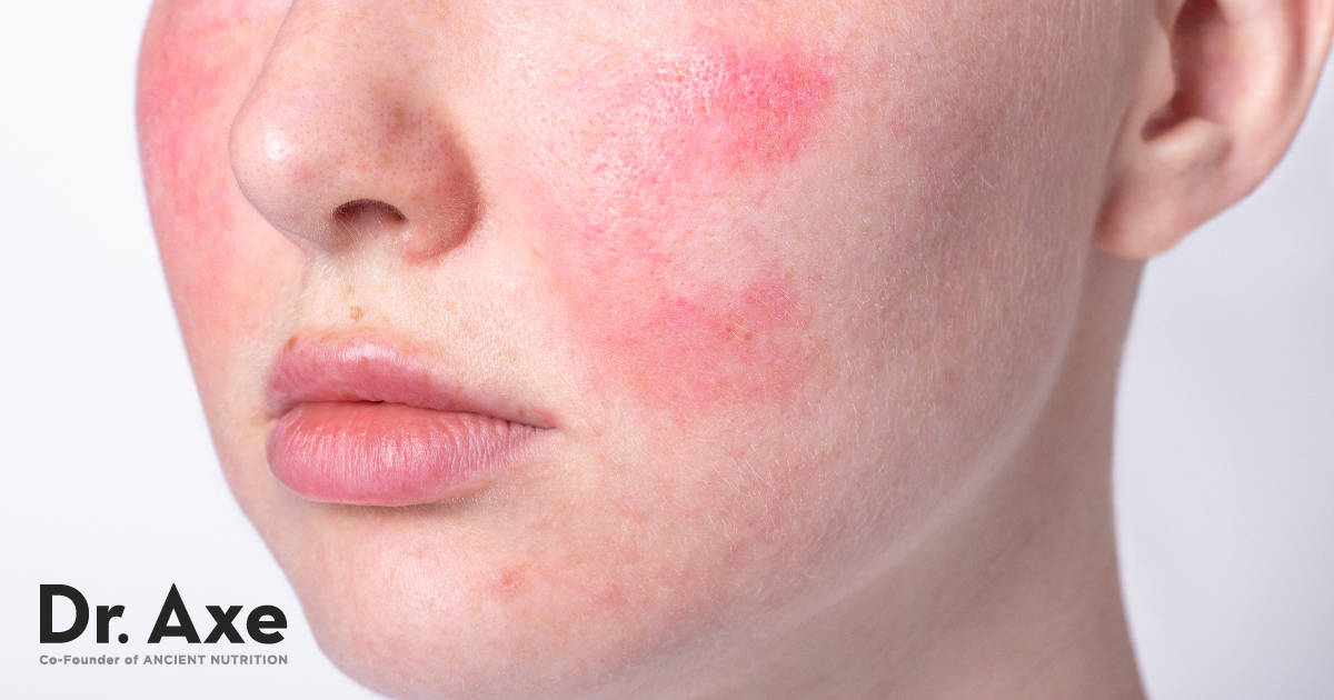 Rosacea Treatment: 6 Natural Remedies to Use - Dr. Axe