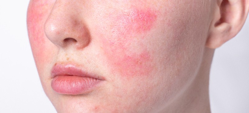 Rosacea Treatment: 6 Natural Remedies to Use - Dr. Axe