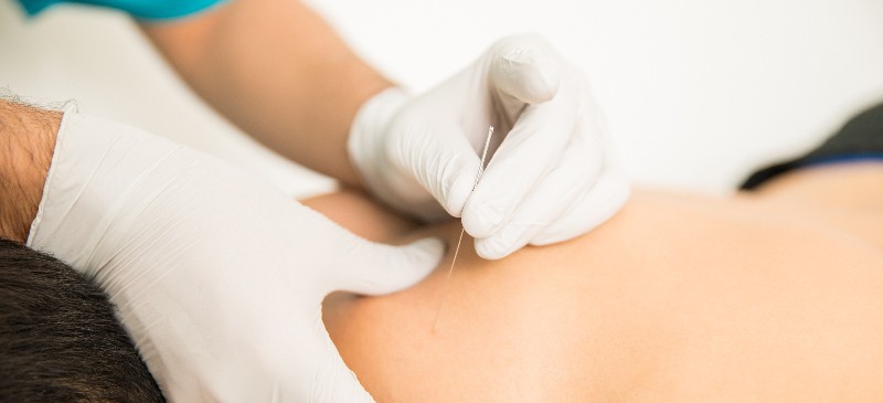 What is dry needling? - Dr. Axe