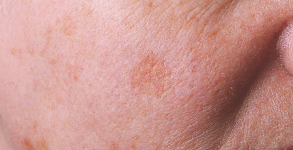 bright pink spots on skin