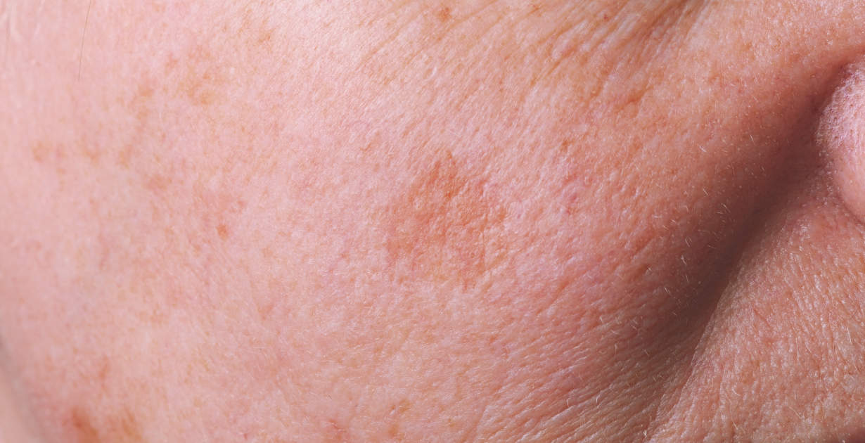 What Are Sunspots on the Skin and How Should I Treat Them?