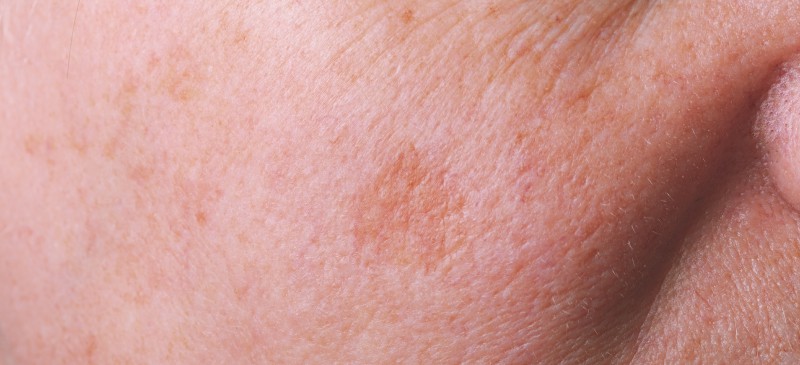 Aging Spots on Legs: What's Normal, What's Not